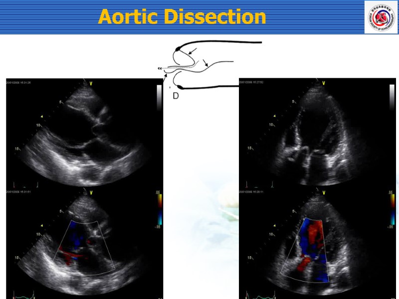 Aortic Dissection